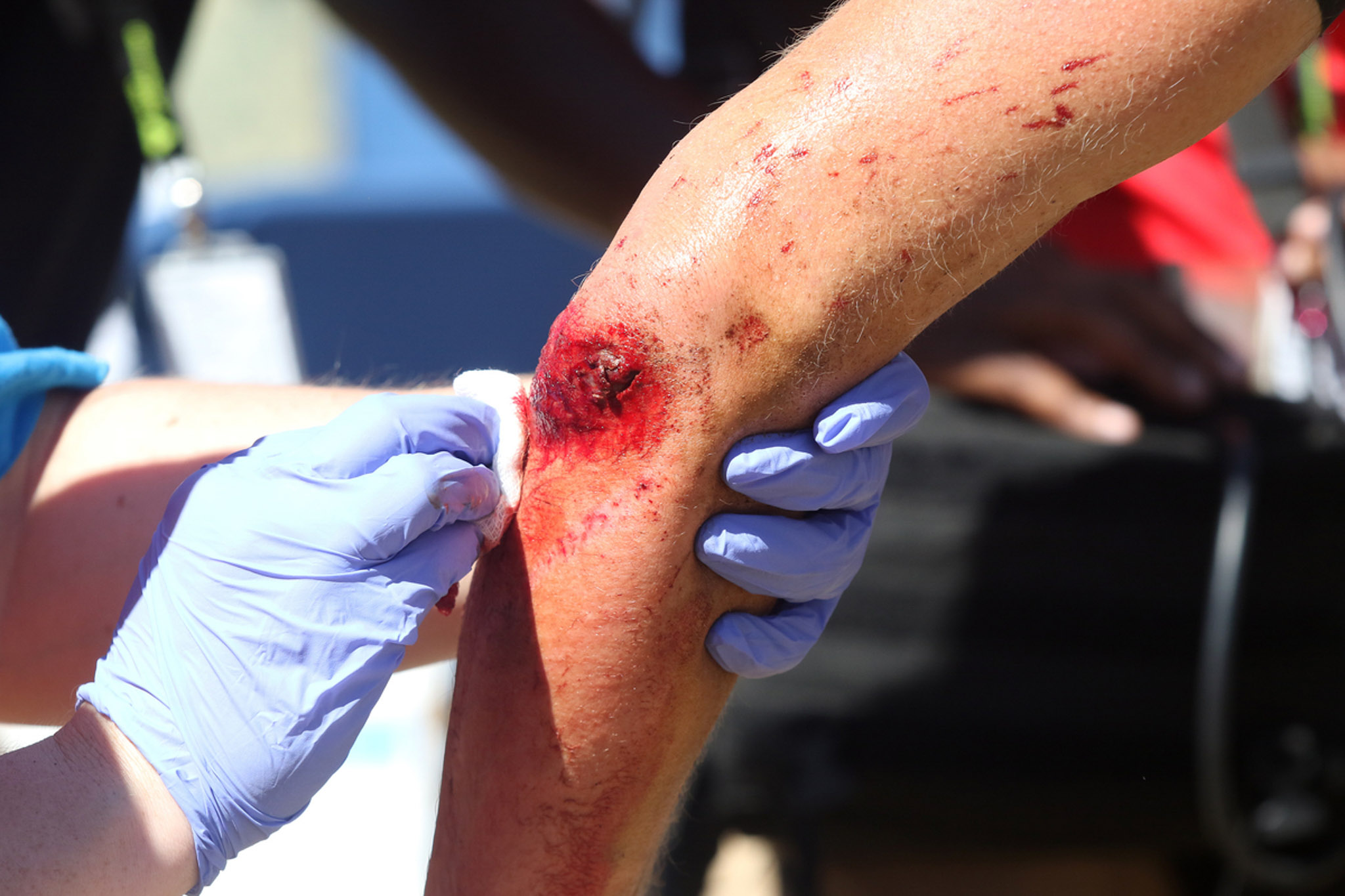 Kristian Hynek of Topeak Ergon Racing gets his injured arm cleaned by the medical staff after falling during stage 3 of the 2016 Absa Cape Epic Mountain Bike stage race held from Saronsberg Wine Estate in Tulbagh to the Cape Peninsula University of Technology in Wellington, South Africa on the 16th March 2016 Photo by Shaun Roy/Cape Epic/SPORTZPICS PLEASE ENSURE THE APPROPRIATE CREDIT IS GIVEN TO THE PHOTOGRAPHER AND SPORTZPICS ALONG WITH THE ABSA CAPE EPIC {ace2016}