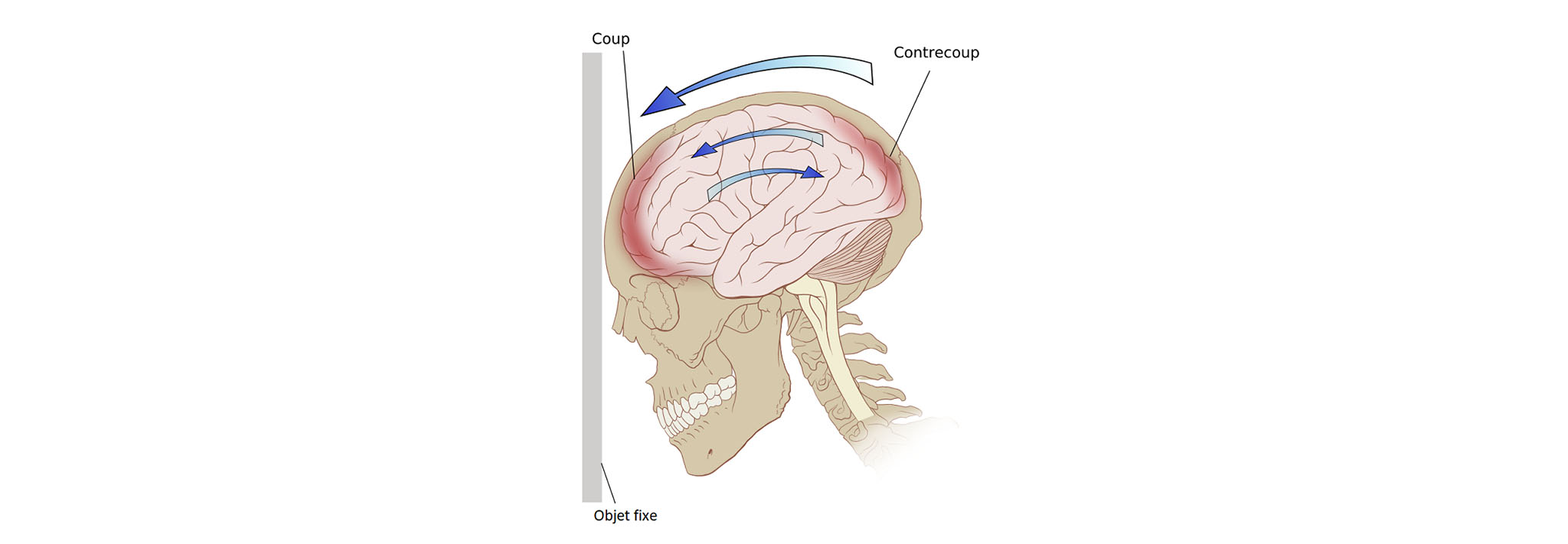 Сотрясение мозга армия. Черепно-мозговая травма. ЛФК при черепно-мозговой травме. Закрытые черепно мозговые травмы.